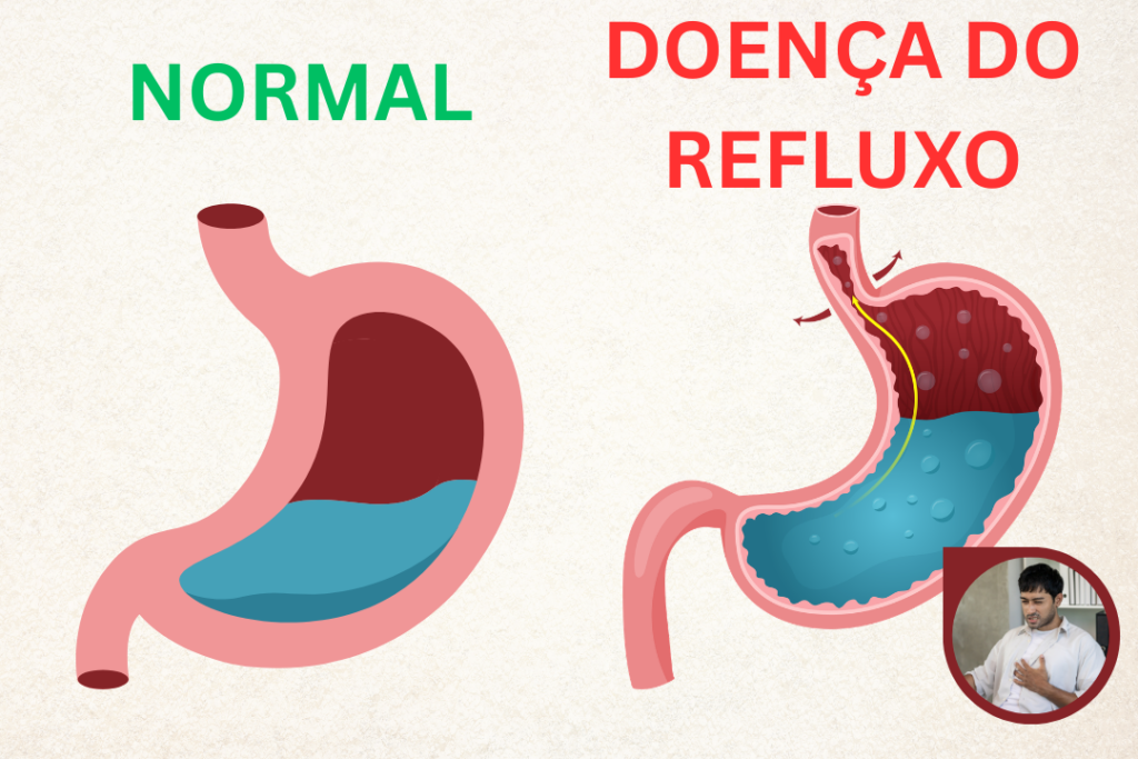 REFLUXO, AZIA, QUEIMAÇÃO
